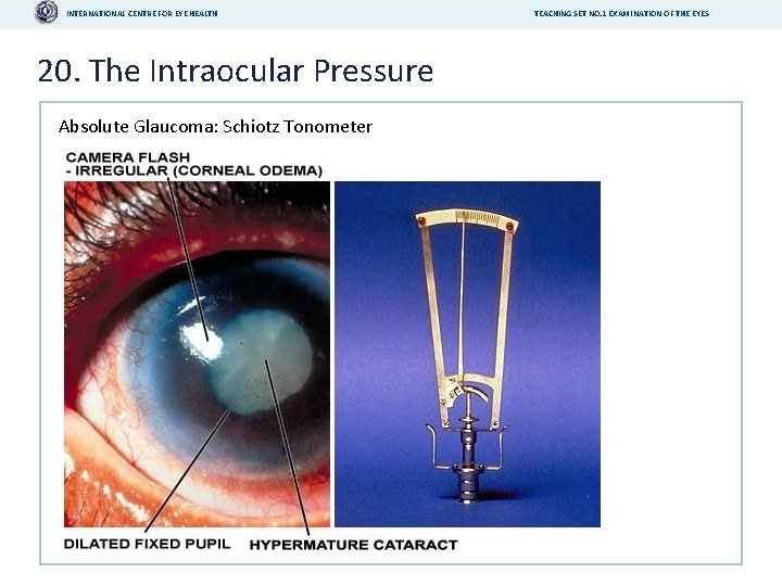 INTERNATIONAL CENTRE FOR EYE HEALTH 20. The Intraocular Pressure Absolute Glaucoma: Schiotz Tonometer TEACHING