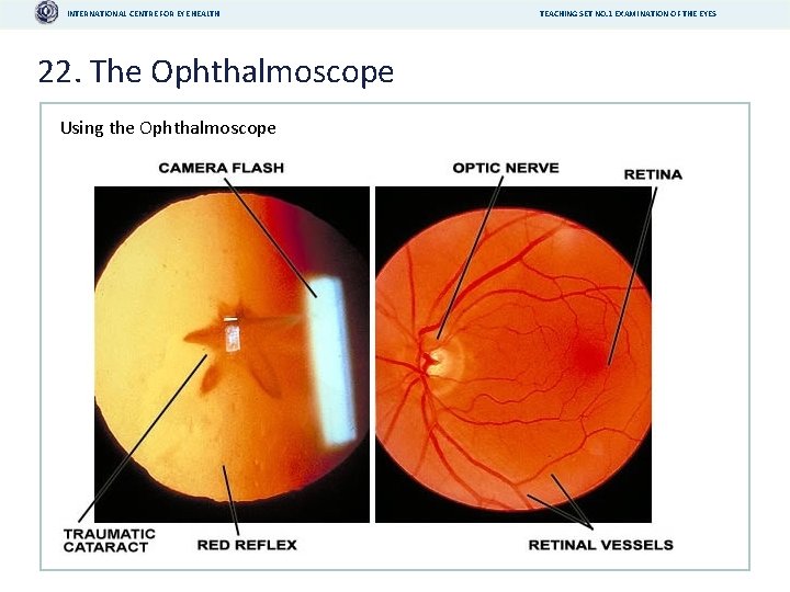 INTERNATIONAL CENTRE FOR EYE HEALTH 22. The Ophthalmoscope Using the Ophthalmoscope TEACHING SET NO.
