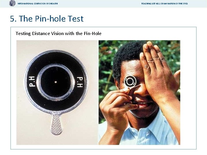 INTERNATIONAL CENTRE FOR EYE HEALTH 5. The Pin-hole Testing Distance Vision with the Pin-Hole