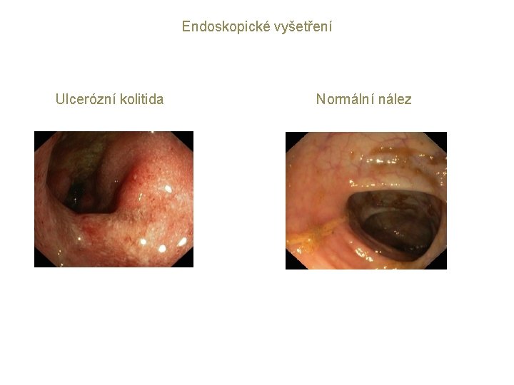 Endoskopické vyšetření Ulcerózní kolitida Normální nález 