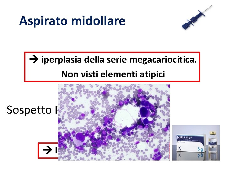 Aspirato midollare iperplasia della serie megacariocitica. Non visti elementi atipici Sospetto PTI…. Infusione Ig