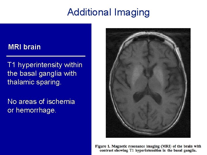 Additional Imaging MRI brain T 1 hyperintensity within the basal ganglia with thalamic sparing. Additional Imaging MRI brain T 1 hyperintensity within the basal ganglia with thalamic sparing.