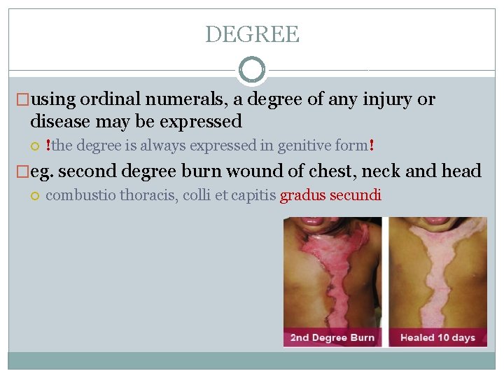 DEGREE �using ordinal numerals, a degree of any injury or disease may be expressed DEGREE �using ordinal numerals, a degree of any injury or disease may be expressed