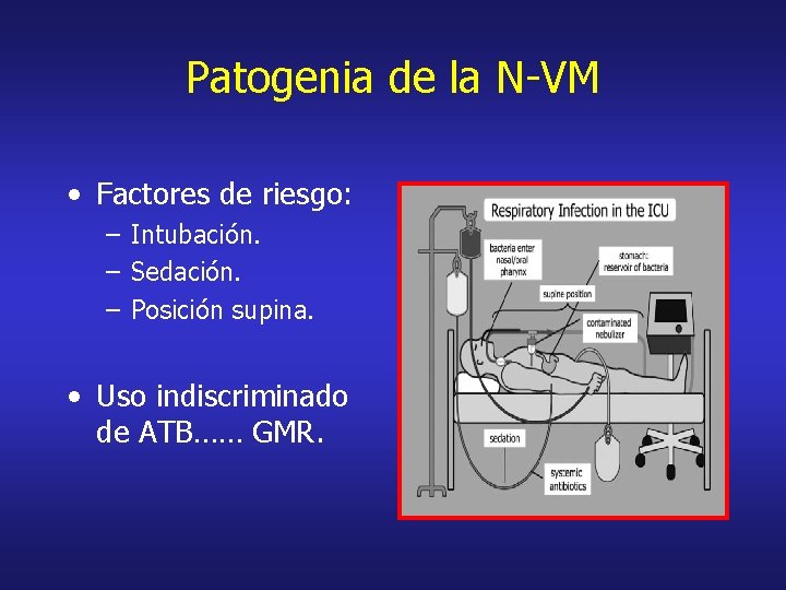Patogenia de la N-VM • Factores de riesgo: – Intubación. – Sedación. – Posición