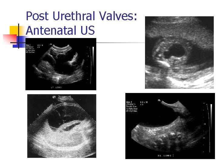 Post Urethral Valves: Antenatal US 11 