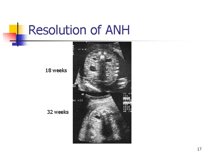 Resolution of ANH 18 weeks 32 weeks 17 