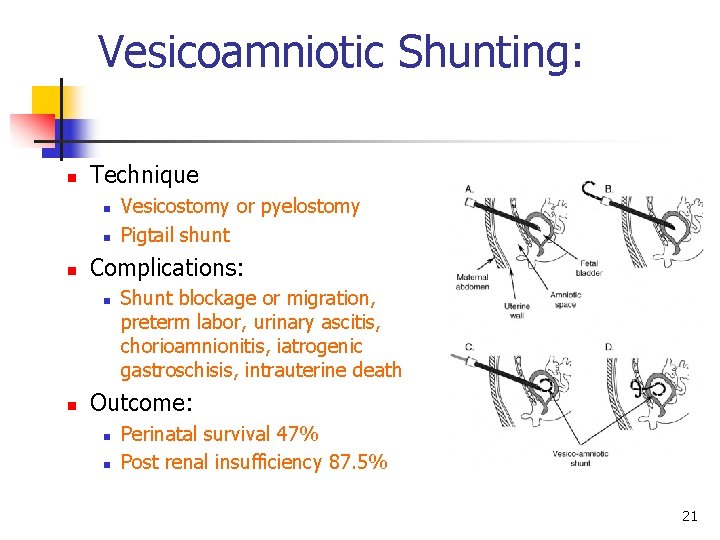 Vesicoamniotic Shunting: n Technique n n n Complications: n n Vesicostomy or pyelostomy Pigtail