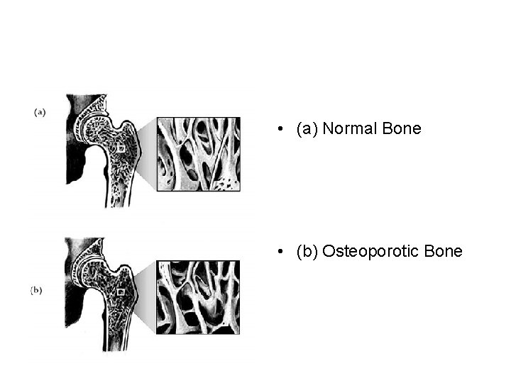  • (a) Normal Bone • (b) Osteoporotic Bone 