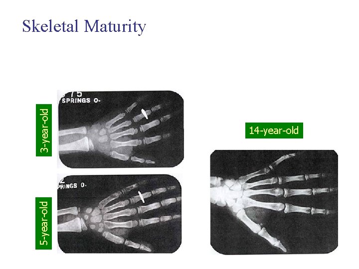 5 -year-old 3 -year-old Skeletal Maturity 14 -year-old 