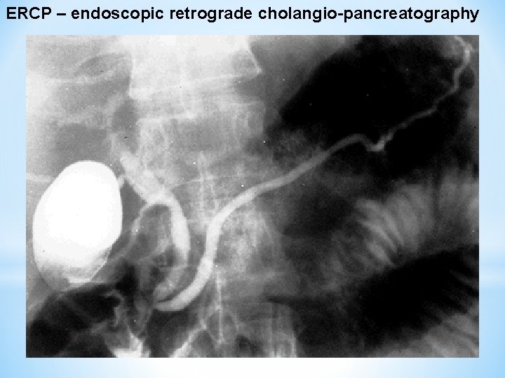 ERCP – endoscopic retrograde cholangio-pancreatography 