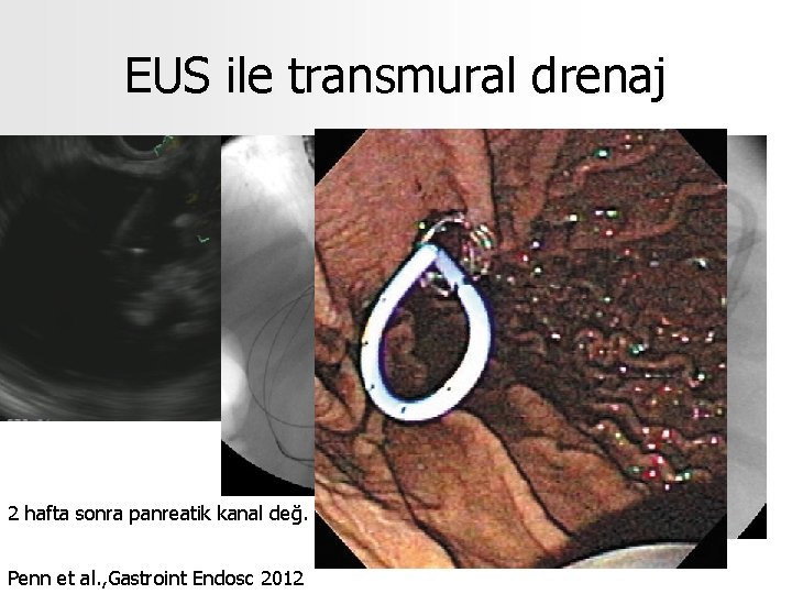 EUS ile transmural drenaj 2 hafta sonra panreatik kanal değ. Penn et al. ,