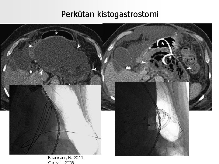 Perkütan kistogastrostomi Bharwani, N. 2011 