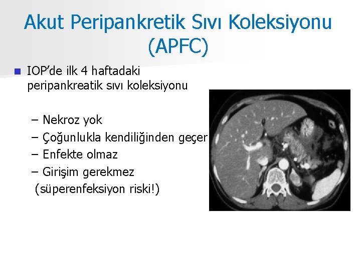 Akut Peripankretik Sıvı Koleksiyonu (APFC) n IOP’de ilk 4 haftadaki peripankreatik sıvı koleksiyonu –