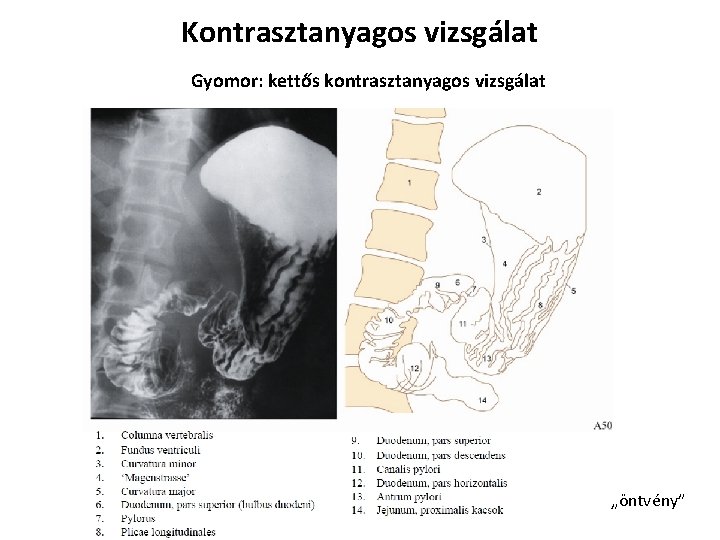 Kontrasztanyagos vizsgálat Gyomor: kettős kontrasztanyagos vizsgálat „öntvény” 