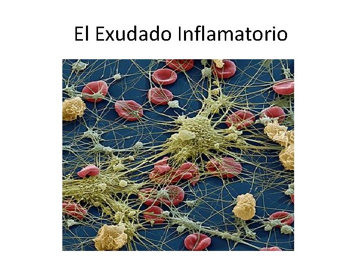 El Exudado Inflamatorio 