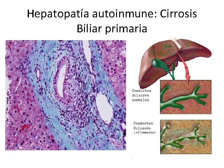 Hepatopatía autoinmune: Cirrosis Biliar primaria 
