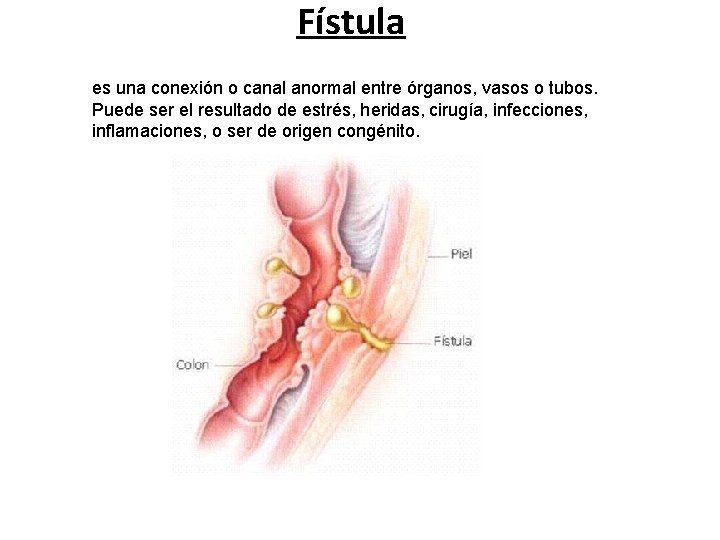 Fístula es una conexión o canal anormal entre órganos, vasos o tubos. Puede ser