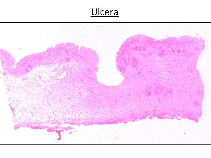 Ulcera Cátedra de Anatomía Patológica. Facultad de Medicina. U. N. T. 