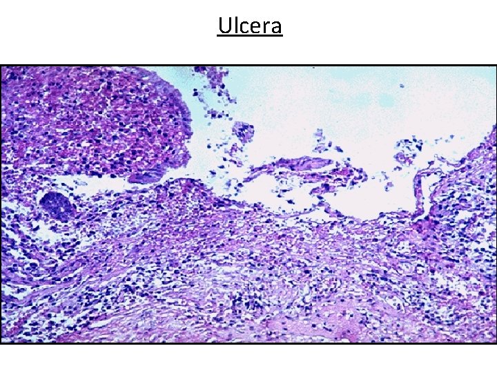 Ulcera Cátedra de Anatomía Patológica. Facultad de Medicina. U. N. T. 