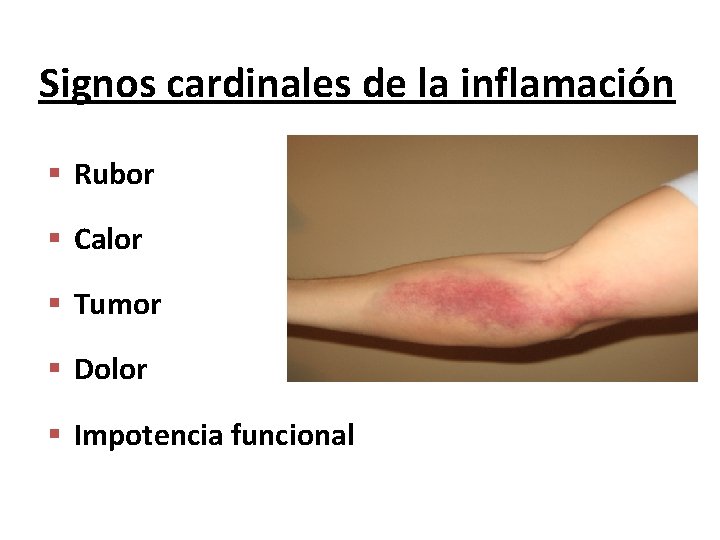 Signos cardinales de la inflamación § Rubor § Calor § Tumor § Dolor §