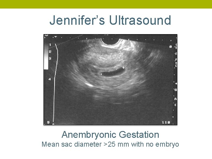 Jennifer’s Ultrasound Anembryonic Gestation Mean sac diameter >25 mm with no embryo 