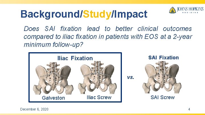 Background/Study/Impact Does SAI fixation lead to better clinical outcomes compared to iliac fixation in