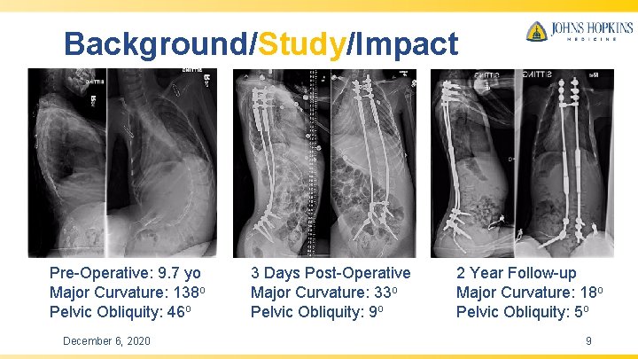 Background/Study/Impact Pre-Operative: 9. 7 yo Major Curvature: 138 o Pelvic Obliquity: 46 o December