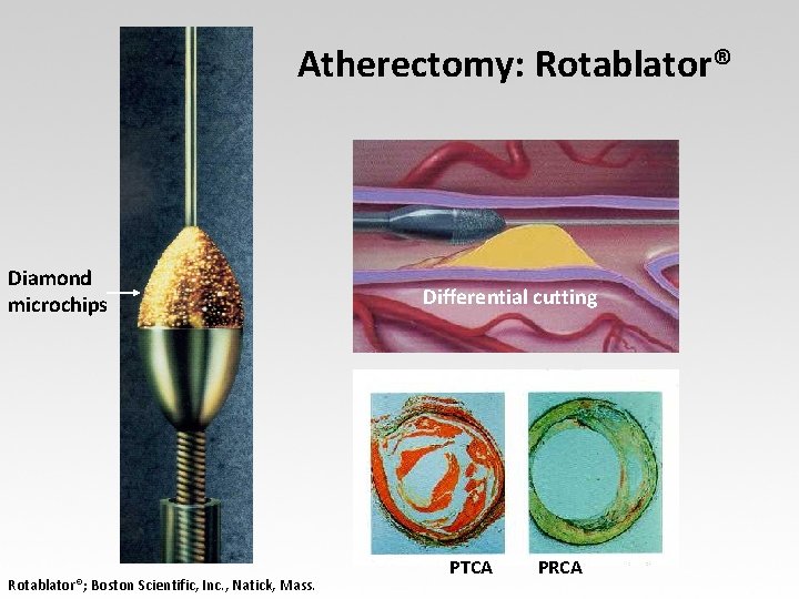 Atherectomy: Rotablator® Diamond microchips Rotablator®; Boston Scientific, Inc. , Natick, Mass. Differential cutting PTCA