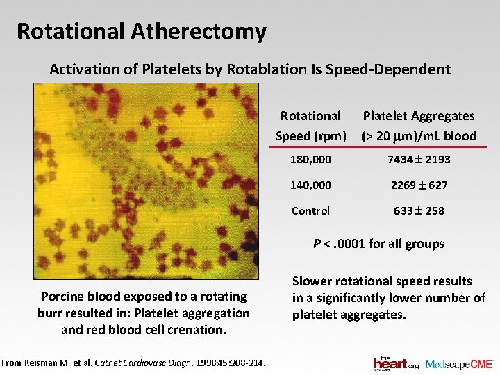 Rotational Atherectomy Activation of Platelets by Rotablation Is Speed-Dependent Rotational Speed (rpm) Platelet Aggregates