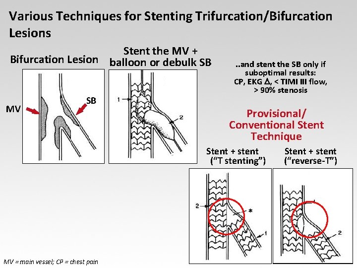 Various Techniques for Stenting Trifurcation/Bifurcation Lesions Stent the MV + Bifurcation Lesion balloon or