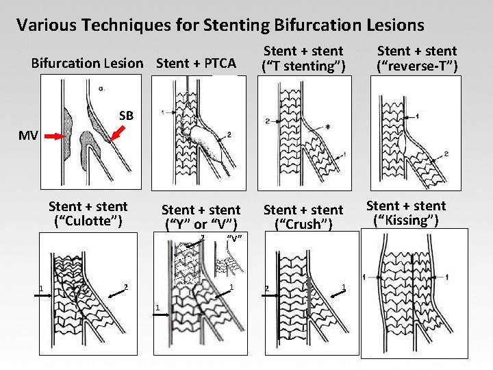 Various Techniques for Stenting Bifurcation Lesions Bifurcation Lesion Stent + PTCA Stent + stent