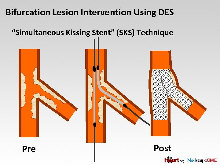 Bifurcation Lesion Intervention Using DES “Simultaneous Kissing Stent” (SKS) Technique Pre Post 
