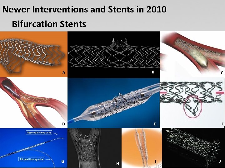 Newer Interventions and Stents in 2010 Bifurcation Stents B A E D G C