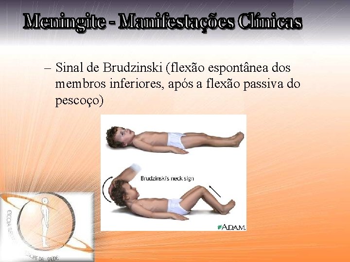 – Sinal de Brudzinski (flexão espontânea dos membros inferiores, após a flexão passiva do
