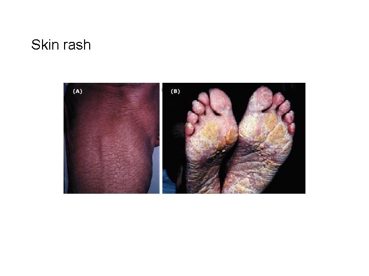 Skin rash 