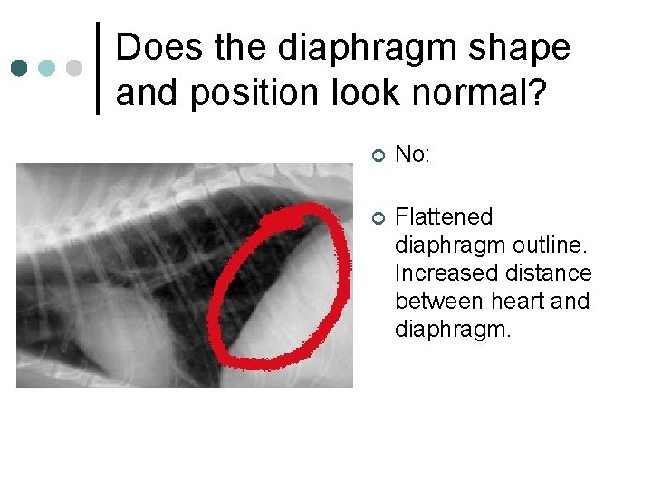 Does the diaphragm shape and position look normal? ¢ No: ¢ Flattened diaphragm outline.
