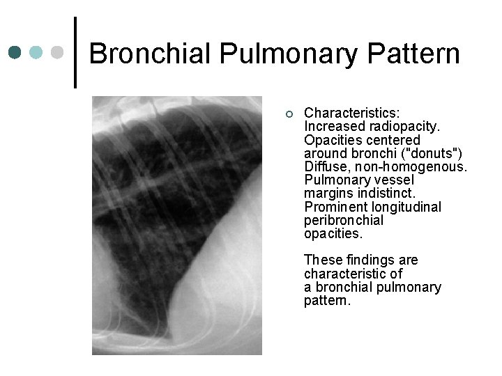 Bronchial Pulmonary Pattern ¢ Characteristics: Increased radiopacity. Opacities centered around bronchi ("donuts") Diffuse, non-homogenous.