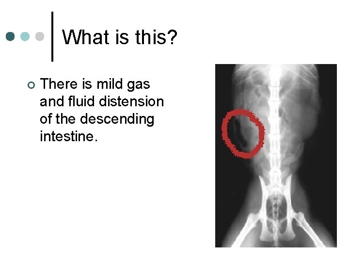 What is this? ¢ There is mild gas and fluid distension of the descending