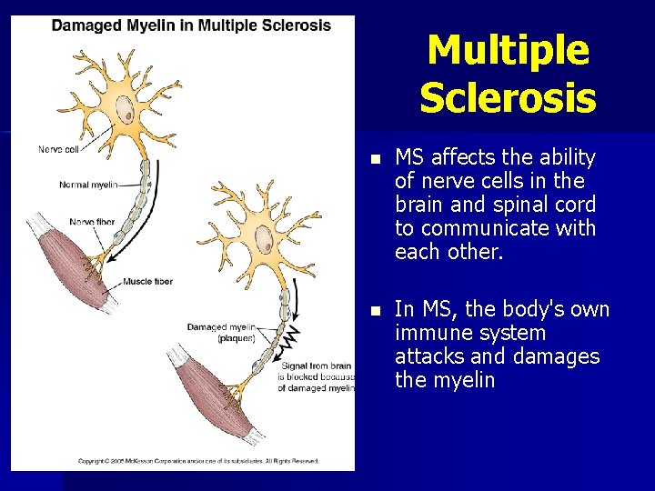 Multiple Sclerosis n MS affects the ability of nerve cells in the brain and