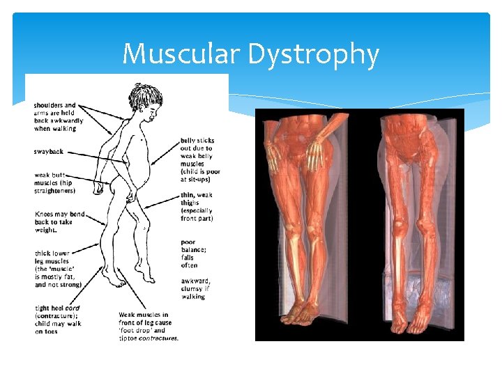 Muscular Dystrophy 