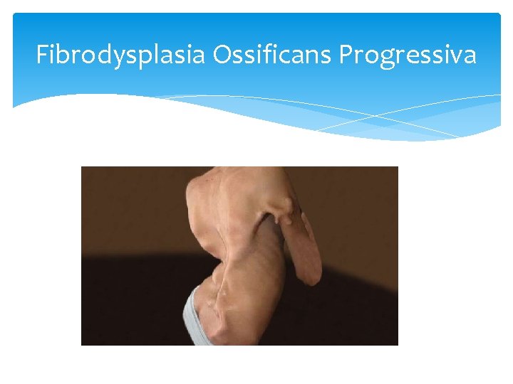 Fibrodysplasia Ossificans Progressiva 