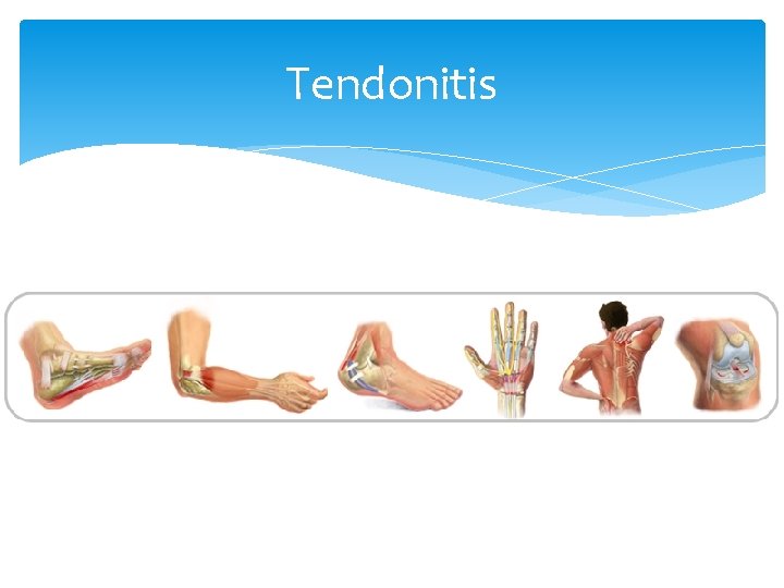 Tendonitis 