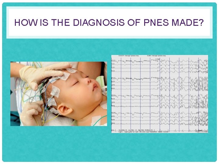 HOW IS THE DIAGNOSIS OF PNES MADE? 