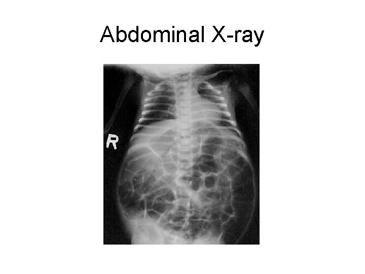 Abdominal X-ray 