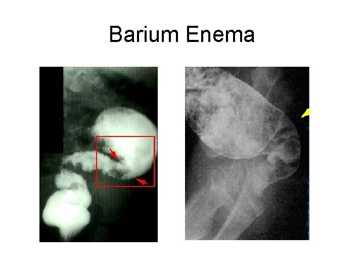 Barium Enema 