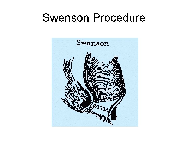 Swenson Procedure 