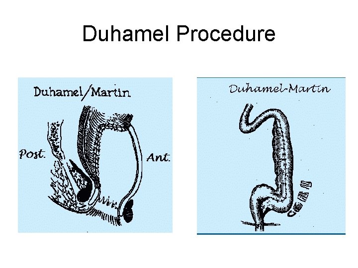 Duhamel Procedure 