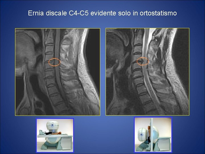 Ernia discale C 4 -C 5 evidente solo in ortostatismo 