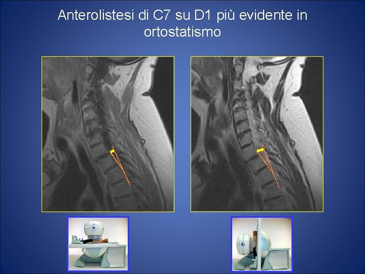 Anterolistesi di C 7 su D 1 più evidente in ortostatismo 