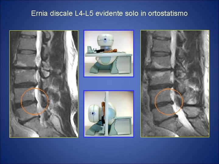 Ernia discale L 4 -L 5 evidente solo in ortostatismo 